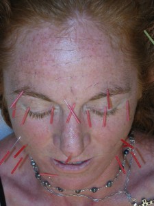 Facial Acupuncture