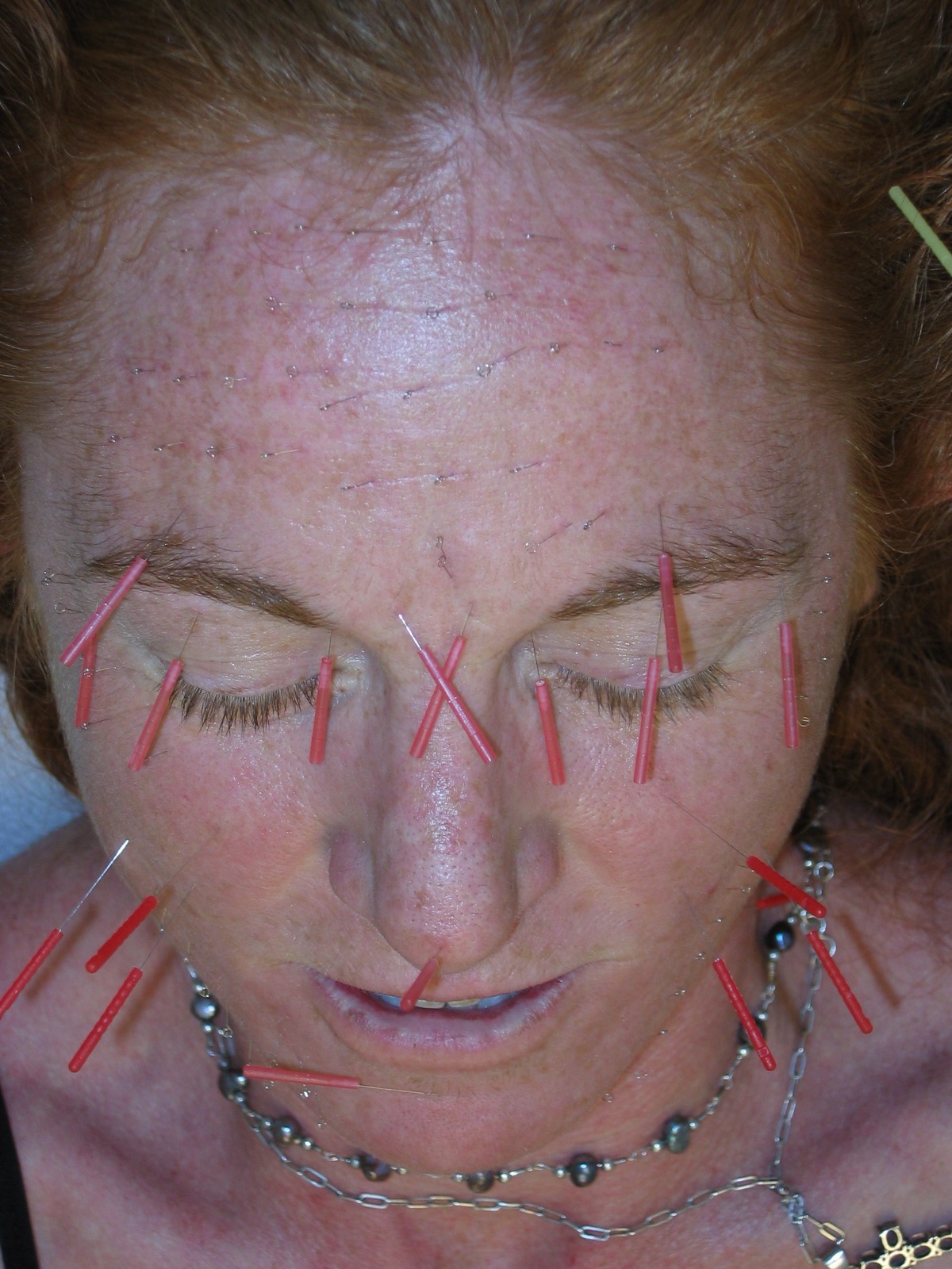 Facial Rejuvenation Cosmetic Acupuncture Points Chart